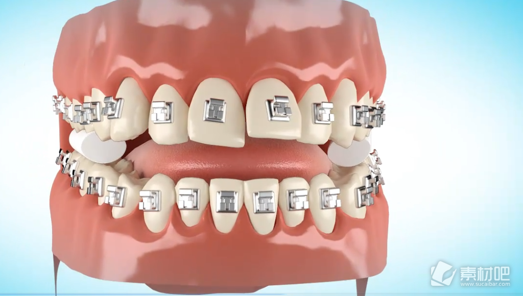 3D技术动画视频全面展示牙齿矫正术全过程